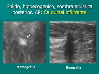 Sólido, hipoecogénico, sombra acústica
posterior. AP: Ca ductal infiltrante
Mamografia Ecografia
 