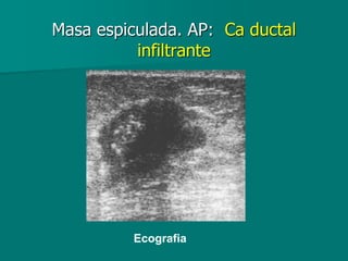 Masa espiculada. AP: Ca ductal
infiltrante
Ecografia
 