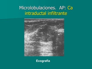 Microlobulaciones. AP: Ca
intraductal infiltrante
Ecografia
 