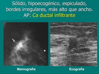 Sólido, hipoecogénico, espiculado,
bordes irregulares, más alto que ancho.
AP: Ca ductal infiltrante
Mamografia Ecografia
 