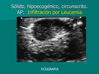 Sólido, hipoecogénico, circunscrito.
AP: Infiltración por Leucemia.
ECOGRAFIA
 
