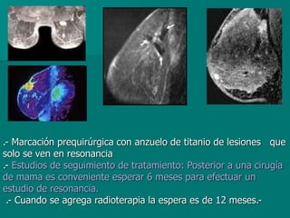 .- Marcación prequirúrgica con anzuelo de titanio de lesiones que
solo se ven en resonancia
.- Estudios de seguimiento de tratamiento: Posterior a una cirugía
de mama es conveniente esperar 6 meses para efectuar un
estudio de resonancia.
.- Cuando se agrega radioterapia la espera es de 12 meses.-
 
