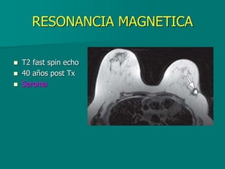 RESONANCIA MAGNETICA
 T2 fast spin echo
 40 años post Tx
 Seroma
 