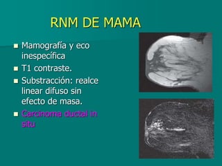 RNM DE MAMA
 Mamografía y eco
inespecífica
 T1 contraste.
 Substracción: realce
linear difuso sin
efecto de masa.
 Carcinoma ductal in
situ
 