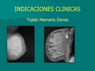 INDICACIONES CLINICAS
Tejido Mamario Denso
 