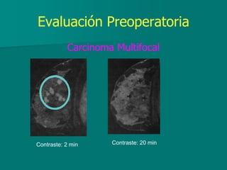 Evaluación Preoperatoria
Carcinoma Multifocal
Contraste: 2 min Contraste: 20 min
 