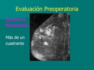 Evaluación Preoperatoria
Carcinoma
Multicéntrico
Más de un
cuadrante
 