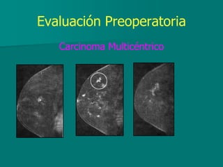 Evaluación Preoperatoria
Carcinoma Multicéntrico
 