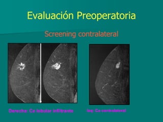 Evaluación Preoperatoria
Screening contralateral
Derecha: Ca lobular infiltrante Izq: Ca contralateral
 