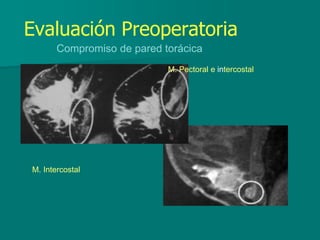 Evaluación Preoperatoria
Compromiso de pared torácica
M. Pectoral e intercostal
M. Intercostal
 