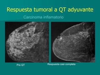 Respuesta tumoral a QT adyuvante
Carcinoma inflamatorio
Pre QT Respuesta casi completa
 