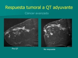 Respuesta tumoral a QT adyuvante
Cáncer avanzado
Pre QT No respuesta
 