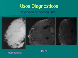 Usos Diagnósticos
Inyección de silicona libre
Mamografía
RMN
 