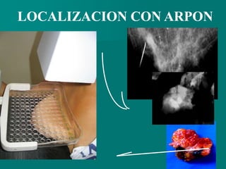 LOCALIZACION CON ARPON
 