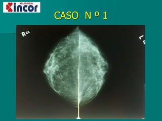 CASO N º 1
 