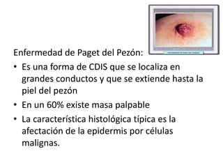 Enfermedad de Paget del Pezón:Es una forma de CDIS que se localiza en grandes conductos y que se extiende hasta la piel del pezónEn un 60% existe masa palpableLa característica histológica típica es la afectación de la epidermis por células malignas.