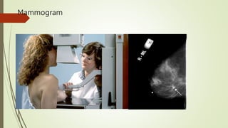 Mammogram Slides Mammary gland .pptx