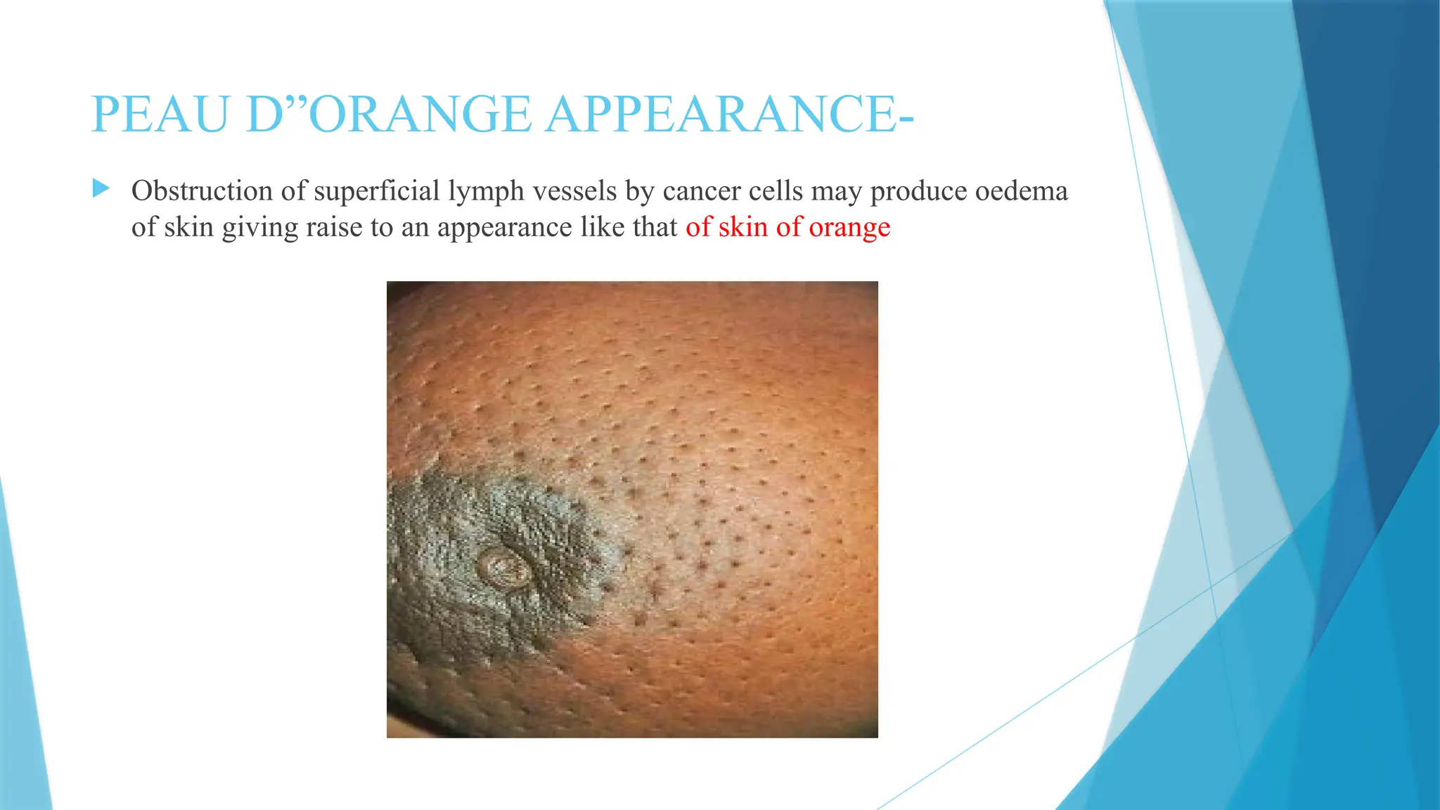 ANATOMY OF MAMMARY GLAND WITH CLINICAL ANATOMY | PPTX