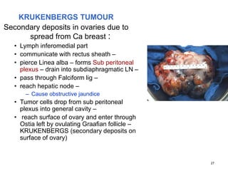 27
KRUKENBERGS TUMOUR
Secondary deposits in ovaries due to
spread from Ca breast :
• Lymph inferomedial part
• communicate with rectus sheath –
• pierce Linea alba – forms Sub peritoneal
plexus – drain into subdiaphragmatic LN –
• pass through Falciform lig –
• reach hepatic node –
– Cause obstructive jaundice
• Tumor cells drop from sub peritoneal
plexus into general cavity –
• reach surface of ovary and enter through
Ostia left by ovulating Graafian follicle –
KRUKENBERGS (secondary deposits on
surface of ovary)
 