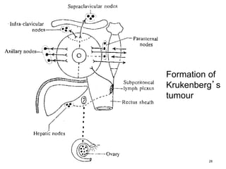 28
Formation of
Krukenberg’s
tumour
 