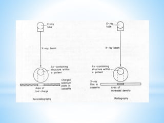 Role of mammography and MRI in Breast disorders | PPTX