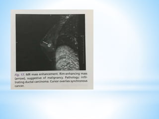 Role of mammography and MRI in Breast disorders | PPTX