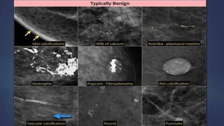Mammogram Slides mammogram ppt on the priciples and application of mammogram | PPTX