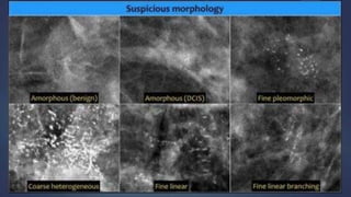 Mammogram Slides mammogram ppt on the priciples and application of mammogram | PPTX