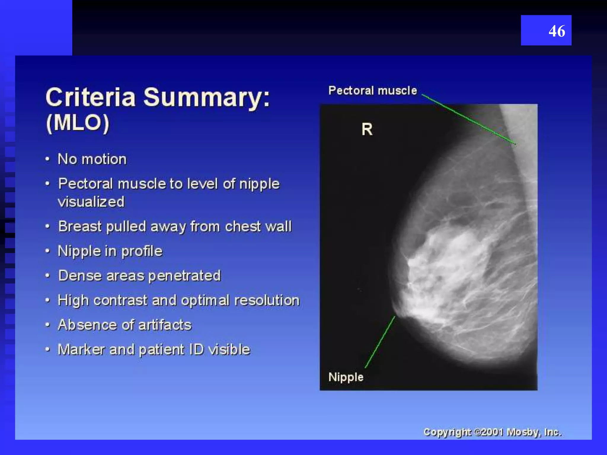 Mammography | PPTX