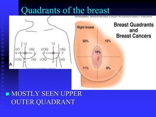 Quadrants of the breast
 MOSTLY SEEN UPPER
OUTER QUADRANT
 