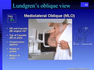 Lundgren’s oblique view 44
 