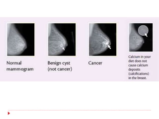 Mammogram Slides A Brief Overview of Mammography | PPTX