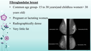 Fibroglandular breast
• Common age group- 15 to 30 years(and childless women> 30
years old)
• Pregnant or lactating women
• Radiographically dense
• Very little fat
10
 