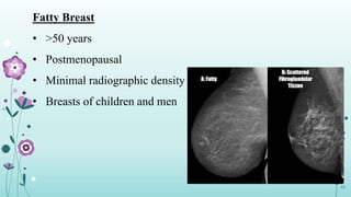 Fatty Breast
• >50 years
• Postmenopausal
• Minimal radiographic density
• Breasts of children and men
12
 