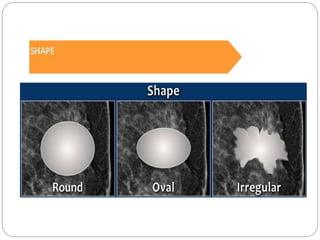 Mammogram Slides Mammography | PPTX