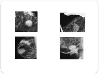 Mammogram Slides Mammography | PPTX