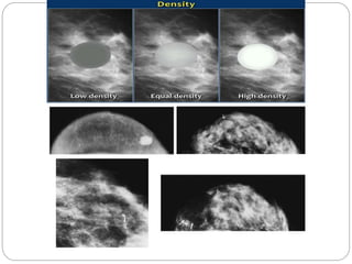 Mammogram Slides Mammography | PPTX