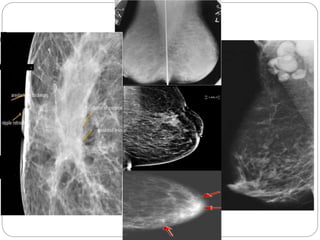 Mammogram Slides Mammography | PPTX