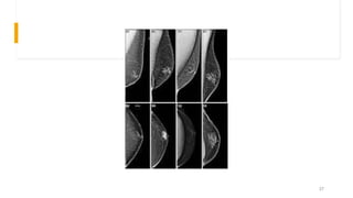 Mammography | PPTX