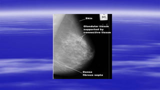 Mammogram Slides mammography.pptx