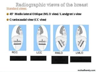 Mammogram Slides MAMMOGRAPHY.pptx