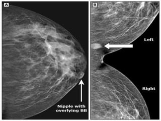 Mammogram Slides MAMMOGRAPHY.pptx