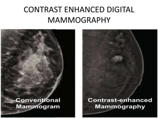 Mammogram Slides MAMMOGRAPHY.pptx