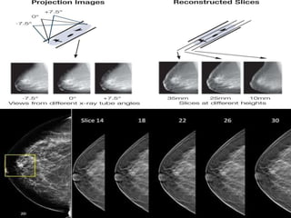 Mammogram Slides Mammography.pptx