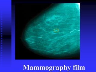 Mammogram Slides Mammography | PPTX
