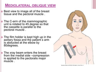 MEDIOLATERAL OBLIQUE VIEW
 Best view to image all of the breast
tissue and the pectoral muscle .
 The C-arm of the mammographic
unit is rotated to 45 degree so that
the cassette is parallel to the
pectoral muscle .
 The film holder is kept high up in the
axillary fossa and the patient s arm
is abducted at the elbow by
80degrees.
 The xray beam enters the breast
from the medial side –compression
is applied to the pectoralis major
muscle .
 