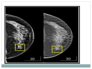 Mammogram Slides MAMMOGRAPHY final.pptx