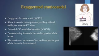 Exaggerated craniocaudal
 Exaggerated craniocaudal (XCCL)
 Show lesions in outer quadrant, axillary tail and
axilla, not seen on CC view
 Extended CC /medial orientation (XXCM)
 Demonstrating lesions in the medial portion of the
breast
 The maximum inclusion of the medio-posterior part
of the breast is demonstrated.
(XXCL)
 