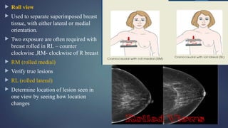  Roll view
 Used to separate superimposed breast
tissue, with either lateral or medial
orientation.
 Two exposure are often required with
breast rolled in RL – counter
clockwise ,RM- clockwise of R breast
 RM (rolled medial)
 Verify true lesions
 RL (rolled lateral)
 Determine location of lesion seen in
one view by seeing how location
changes
 