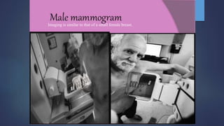 Imaging is similar to that of a small female breast.
 